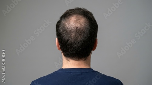 Rear view of a man showing signs of hair loss and thinning crown
