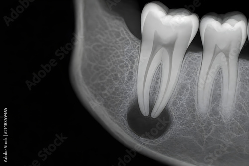 Periapical lesion at tooth root apex in jawbone