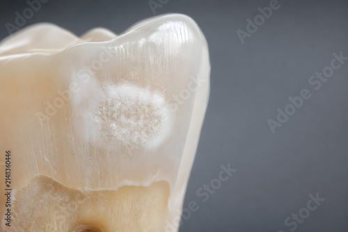 White spot lesion on tooth enamel macro