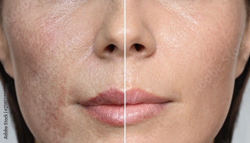 Comparison of human skin with pigment spots and treated smooth healthy facial skin texture