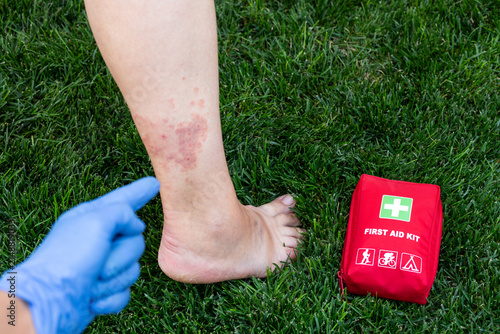 Obraz na płótnie First Aid Assessment of Bruised Lower Leg Outdoors