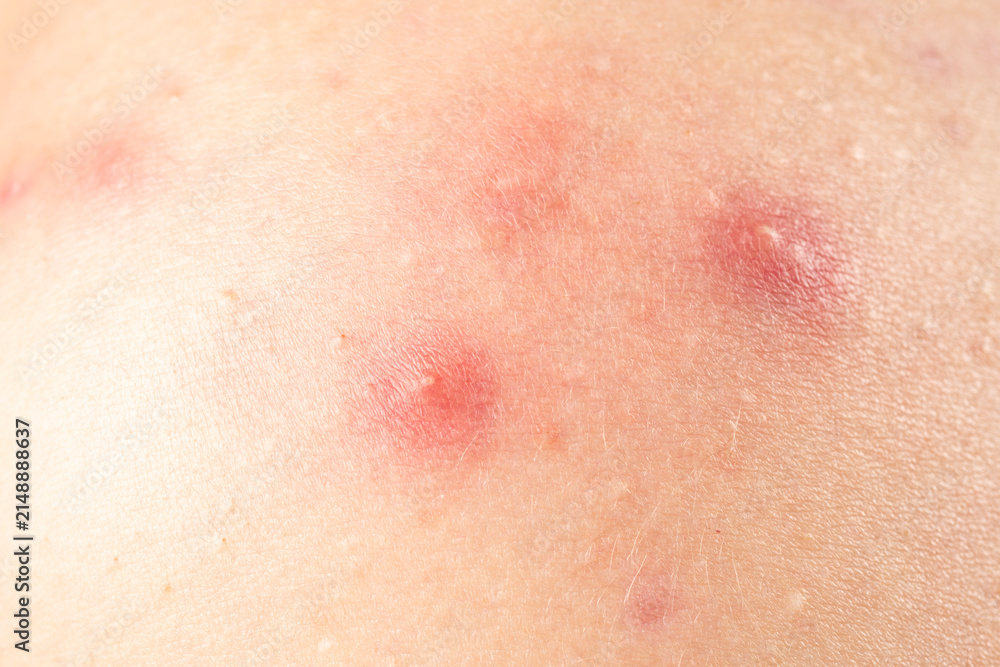 Fototapeta premium Skin rash texture with acne. Inflamed skin bumps acne macro. Close up acne on skin. Irritated acne skin.