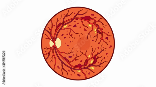 Diabetic Retinopathy Eye Condition Vector Illustration