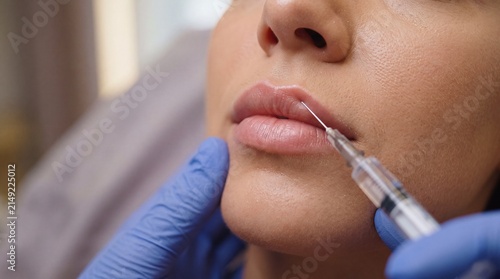 Lip filler injection, cosmetic procedure, close up of woman receiving hyaluronic acid treatment for fuller lips, beauty enhancement, medical aesthetic clinic