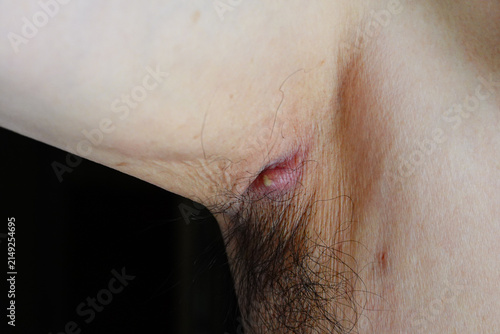 Bild auf Leinwand Purulent abscess underarm, male patient showing a skin pustule infection