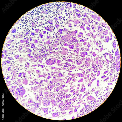 Rosai-Dorfman disease (RDD) also known as sinus histiocytosis is a rare, noncancerous disorder involving the overgrowth and accumulation of white blood cells called histiocytes.