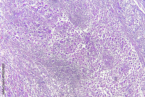 Rosai-Dorfman disease (RDD) also known as sinus histiocytosis is a rare, noncancerous disorder involving the overgrowth and accumulation of white blood cells called histiocytes.
