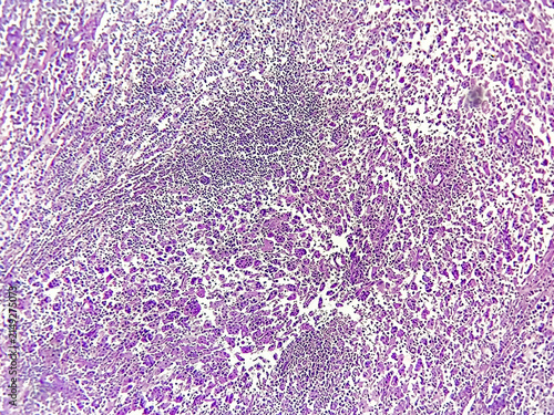 Rosai-Dorfman disease (RDD) also known as sinus histiocytosis is a rare, noncancerous disorder involving the overgrowth and accumulation of white blood cells called histiocytes.