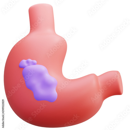 Bild auf Leinwand 3D stomach Cancer Tumor Disease Human Anatomy Organ Medical Healthcare Gastroint
