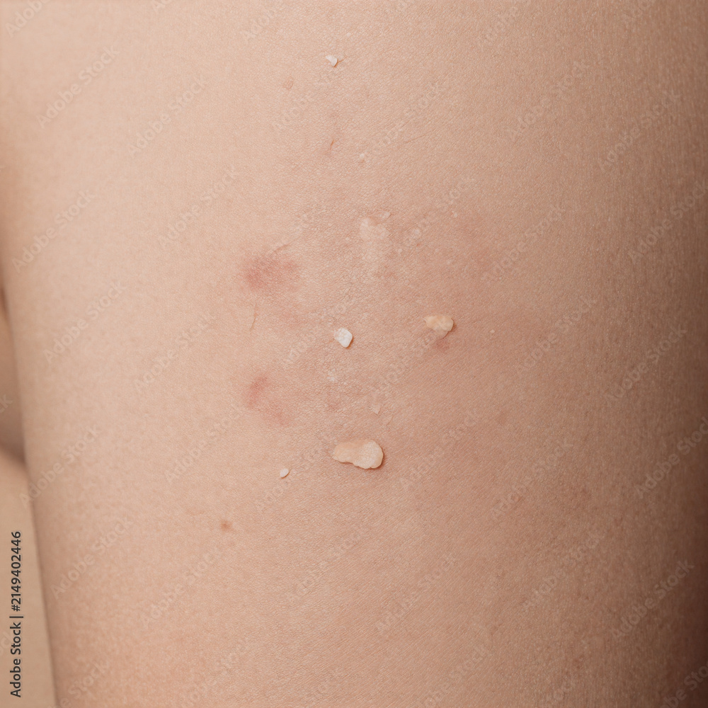 Fototapeta premium Flat Design Texture Unhealthy. Close-Up Of Unhealthy Human Skin Epidermis With Flaky And Cracked Texture