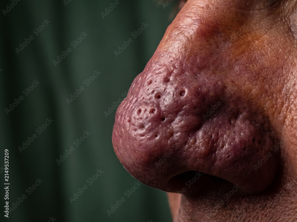 Naklejka premium Rhinophyma Thickened Bulbous Nose Skin from Advanced Rosacea, Sebaceous Hyperplasia Dermatology Medical Reference Photograph