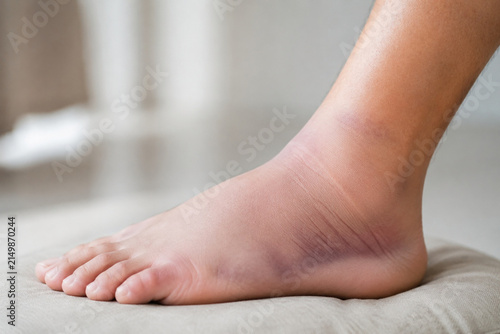 Swollen ankle resting on neutral cushion, injury recovery and healthcare concept