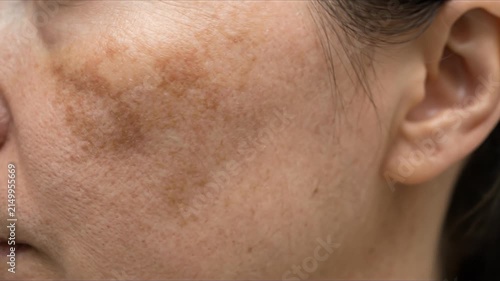 Close up of a woman face with skin pigmentation and melasma patches on her cheek