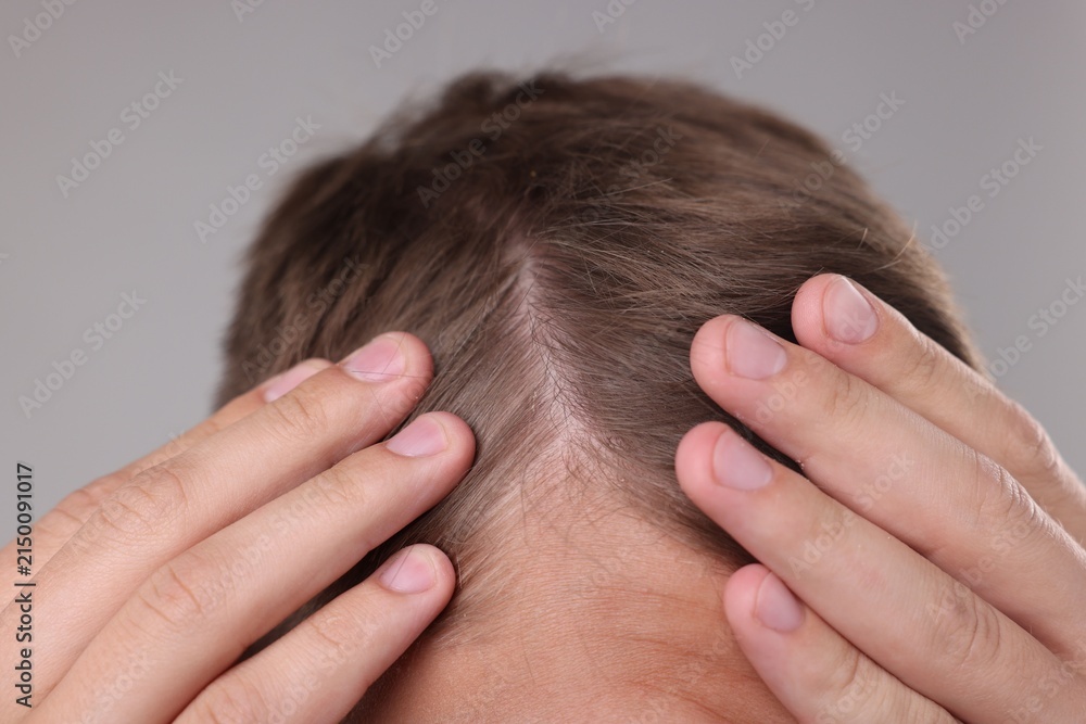 Fototapeta premium Man examining his head on grey background, closeup
