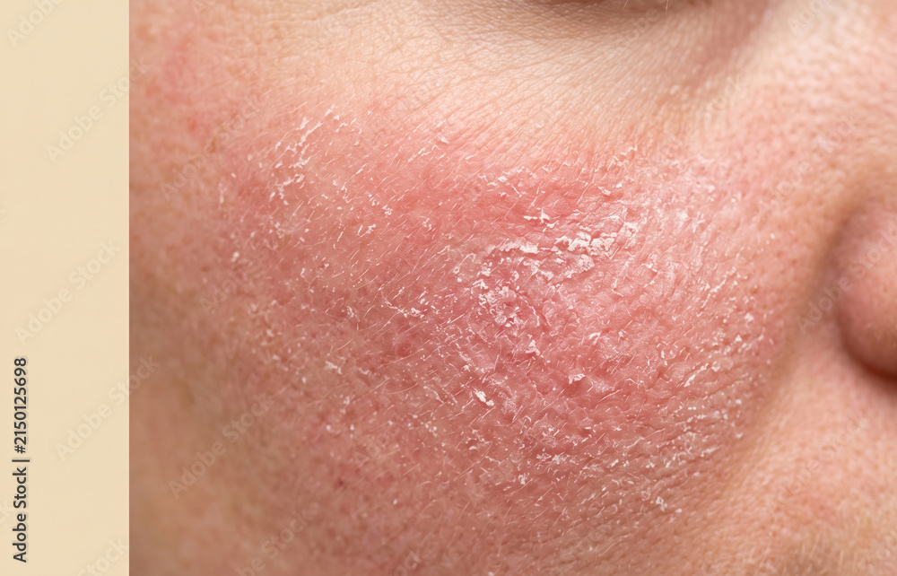 Fototapeta premium Red inflamed rash with flaking skin on cheek from rosacea or dermatitis