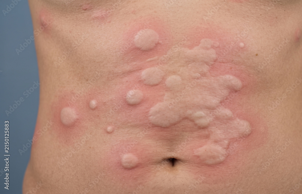 Fototapeta premium Close-up of a human torso covered in large, raised, itchy welts and hives, indicating a severe allergic reaction or urticaria.