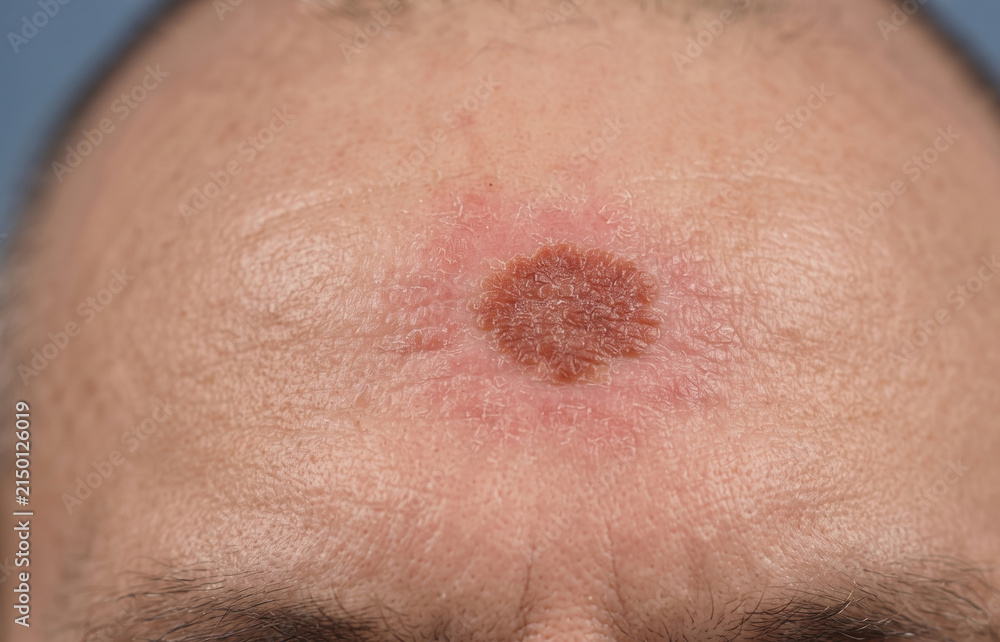 Fototapeta premium Macro close-up of a forehead showing a reddish-brown, crusty skin lesion, indicative of actinic keratosis or skin cancer development.
