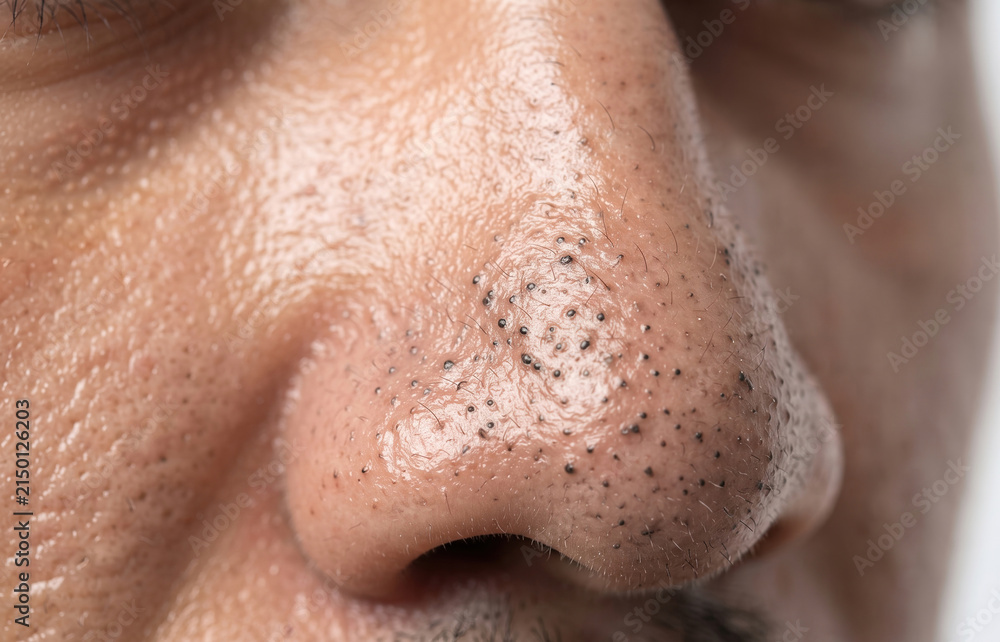 Fototapeta premium Extreme close-up of a male nose covered in numerous prominent blackheads, enlarged pores, and oily skin, highlighting dermatological issues.