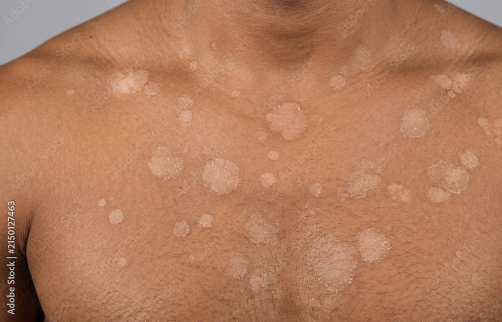 Fototapeta premium Tinea Versicolor Hypopigmentation Patches on Male Chest