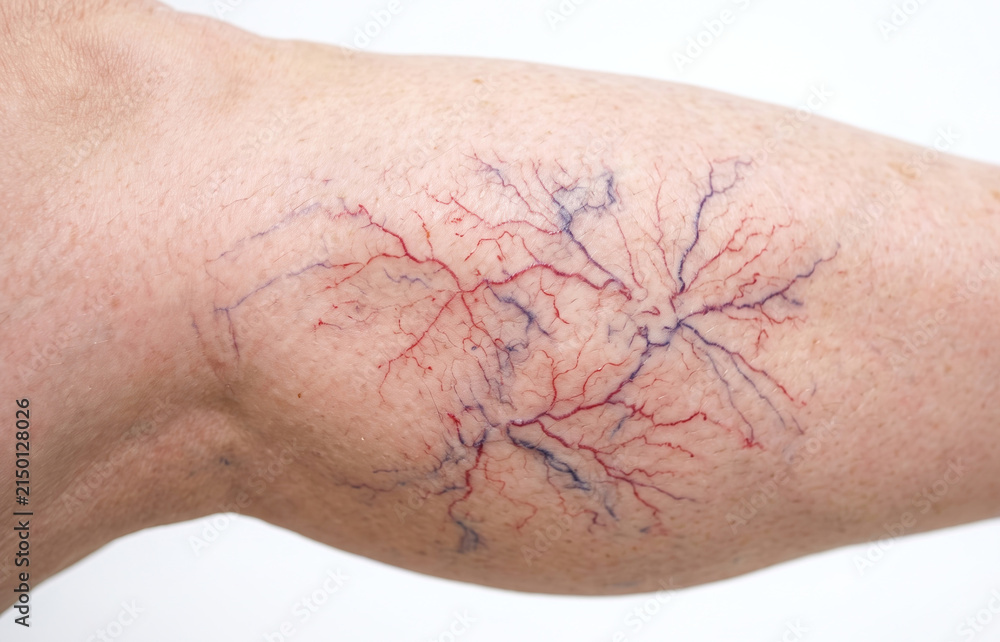 Fototapeta premium Close-up of a person's skin displaying prominent spider veins, varicose veins, and telangiectasia on the leg.