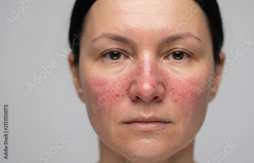 Front portrait of a woman face with severe rosacea redness and inflammatory papules