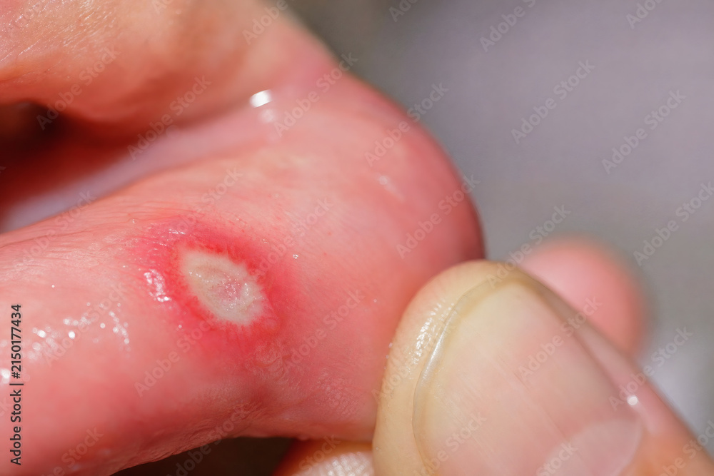 Fototapeta premium Aphthous Ulcer With White Yellow Center and Red Inflammatory Border