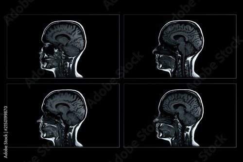 Brain MRI scan sequence showing sagittal views of human head in four frames grid