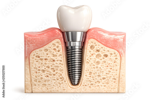 dental implant cross-section