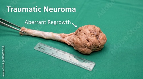 Surgical specimen of traumatic neuroma with aberrant nerve regrowth on sterile medical tray