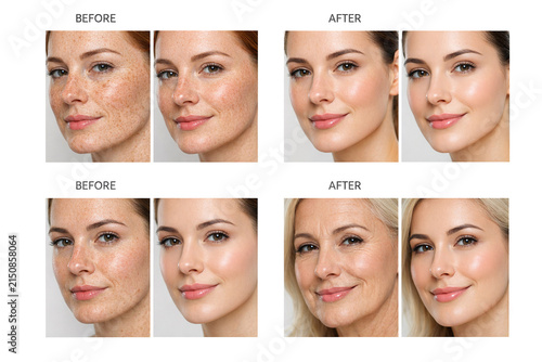A woman smiling before and after a skin treatment to reduce acne.