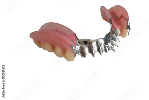 A lower jaw partial denture with a metal frame and clasps for fixation. The core is a durable cast metal clasp that evenly distributes chewing forces between the gums and supporting teeth.