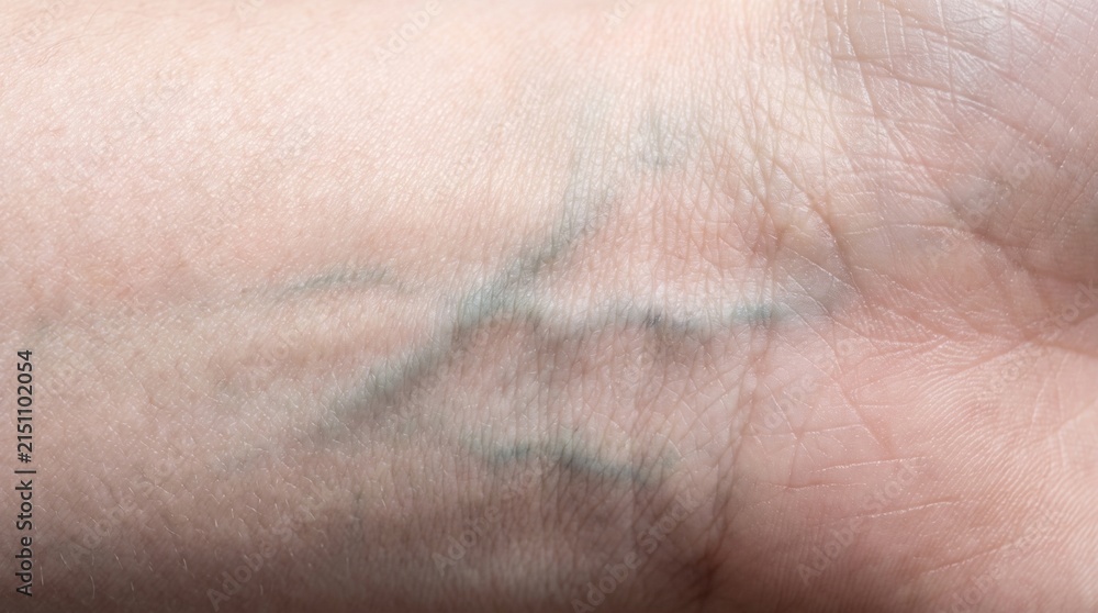 Fototapeta premium Close-up of Visible Superficial Veins on Human Forearm and Wrist