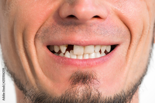 smile with missing tooth close-up. Dental surgery and implantation. Portrait of an adult man with upper front tooth removed on a white background