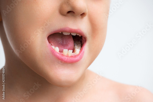 Foto Close-up of a child with a missing tooth, illustrating childhood dental developm