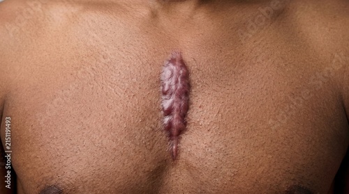 Severe Vertical Keloid Surgical Scar on Chest of Dark Skinned African American Man