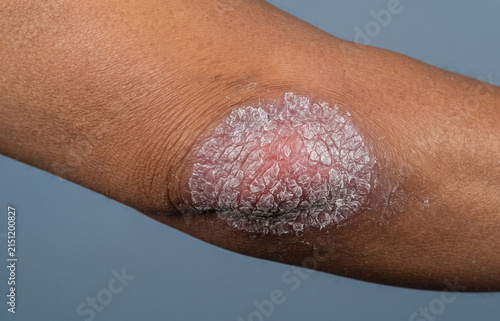 Close up of a thick psoriasis scaly plaque on dark skin elbow