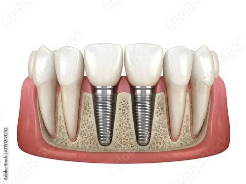 Medical illustration of two dental implants in human jaw bone isolated on transparent background