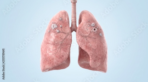 Pulmonary tuberculosis shown in premium clinical CGI with upper lung granulomatous lesions and small cavitary changes on clean medical background