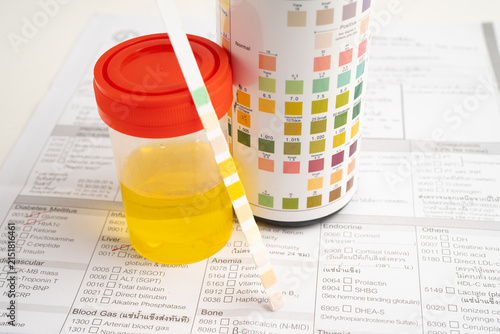 Fotografie Urinalysis, urine cup with reagent strip pH paper test and comparison chart in laboratory