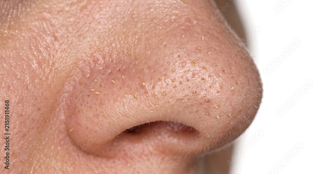 Fototapeta premium Extreme macro of clogged nose skin pores with blackheads and whiteheads