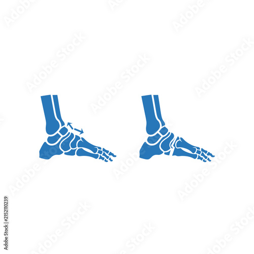 Ankle and foot bone anatomy showing joint flexibility or injury