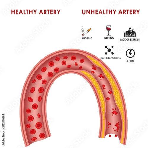Healthy vs unhealthy artery medical comparison diagram