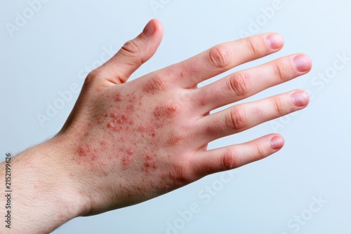 Red bumps fluid blisters, sores on person hand skin. Patient with viral infection chickenpox, pox, shingles or dermatitis. Monkey Pox MPOX disease symptom sign. Marv Painful rash, spots close up body