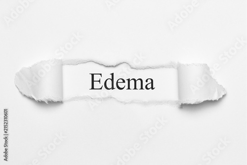 Foto Edema
