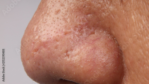 Cuadro en lienzo a human nose showing severe skin problems