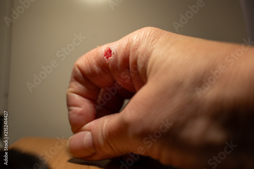 Injured finger on a hand