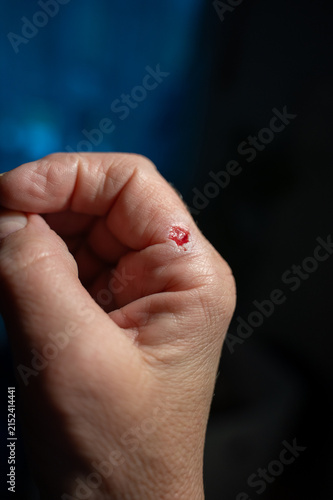 Injured finger on a hand