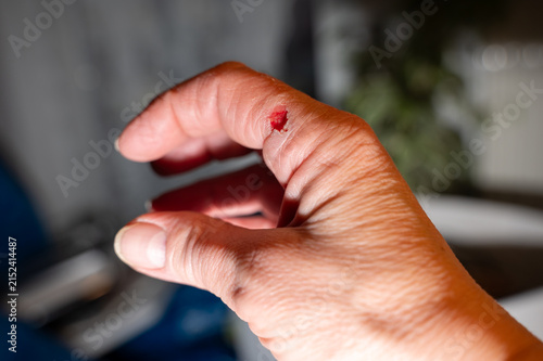 Injured finger on a hand