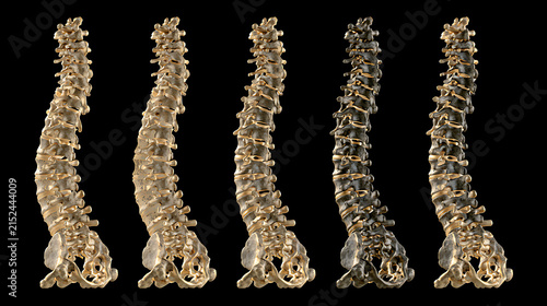 Obraz na płótnie Human spinal columns demonstrate progressive bone density loss and curvature