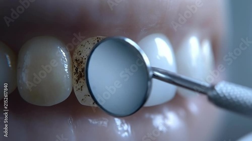 Close-up of teeth with plaque stains and dental mirror